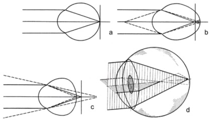 Imperfectarea sistemului optic al ochiului