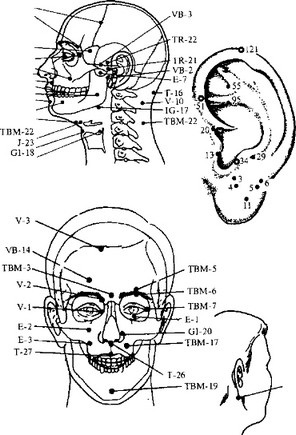 A trigeminus idegi neuralgia