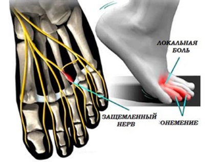 Neuroma Moront - simptome, diagnostic, tratament