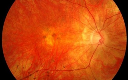 Az új teszt glaukóma lehet kezdeni kezelés előtt a tünetek látásvesztés