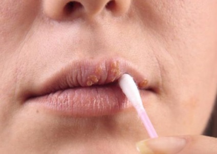 Cum sa scapi de papilom pe buze - Dermatită - Papiloame pe buzele tratament