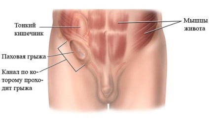 Hernia inghinala dupa reabilitarea si nutritia chirurgicala