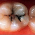 De ce dinții vorbeau într-un vis, cauze și tratament