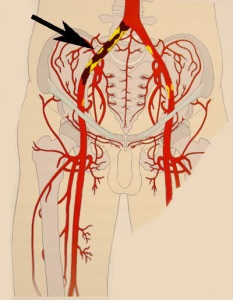 Artera iliacă, anatomie, boală