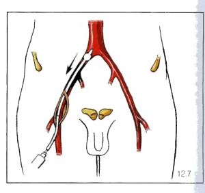 Artera iliacă, anatomie, boală