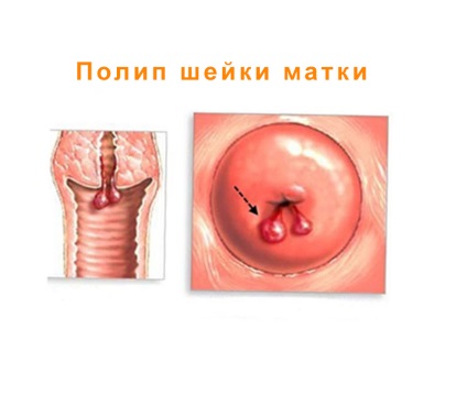 Diagnosticul modern al polipilor de col uterin, fibroase