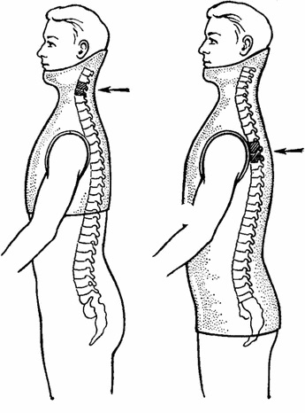 Nyaki vertebra károsodás és tünetek, traumatológia