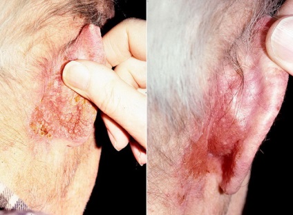 Boli precanceroase ale pielii ca timp pentru a recunoaște patologia