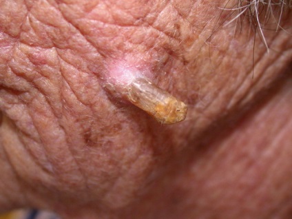 Boli precanceroase ale pielii ca timp pentru a recunoaște patologia