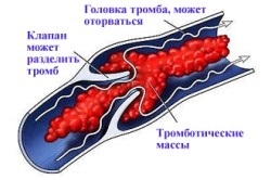 Medicamente pentru tratamentul tromboflebitei