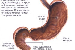 Prevenirea ulcerului gastric 1