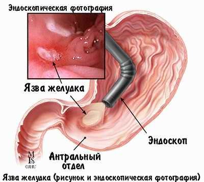 Prevenirea ulcerului la stomac - ce să faceți