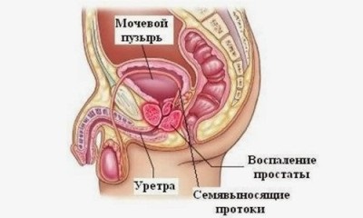 Prostatita la bărbați, simptome, cauze, semne, cum să tratăm