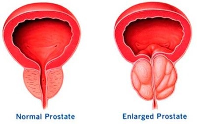 Prostatita la bărbați, simptome, cauze, semne, cum să tratăm