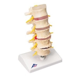 Manifestarea herniilor coloanei vertebrale se poate dizolva dispar, după cum se poate vedea