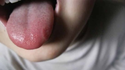 Vesicule în fotografia, tratamentul și cauzele limbii copilului