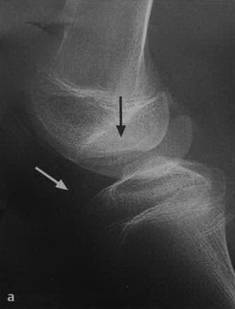 Osteochondritis boncolása