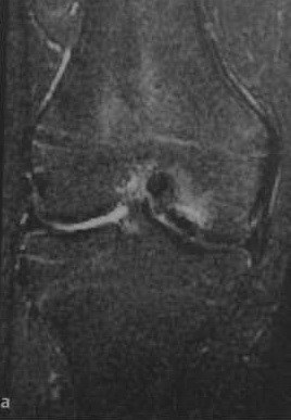 Osteochondritis boncolása