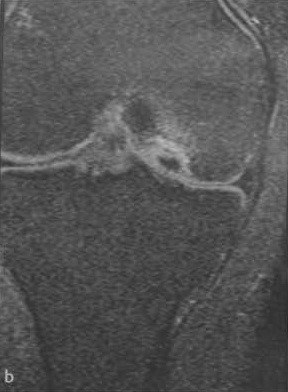 Osteochondritis boncolása