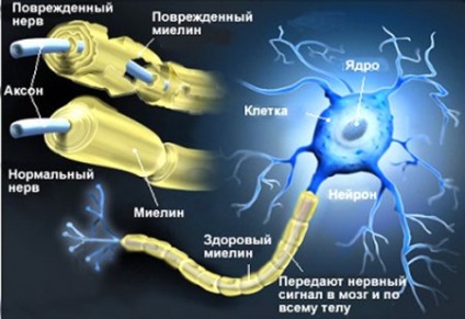 Scleroza multiplă - cauze și simptome