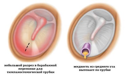 Copilul aude rău după otitis ce să facă