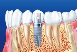 Recomandări pentru pacient la implantarea dinților