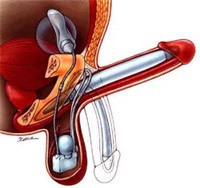 Metode moderne de tratare a impotenței, andrologiei (boli masculine), impotență și probleme cu