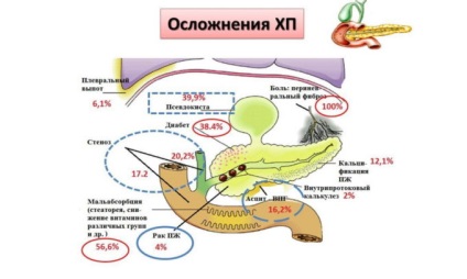 Metode moderne de tratare a pancreatitei acute și cronice