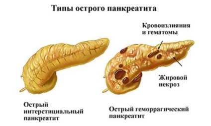 Metode moderne de tratare a pancreatitei acute și cronice