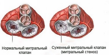 Mitralis stenosis tünetek gyermekeknél, kezelésére, a műtét