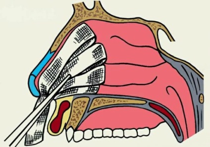 Tamponarea tipurilor de nas și tehnica de performanță
