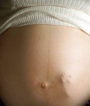 Terzhinan în timpul sarcinii când și când se aplică