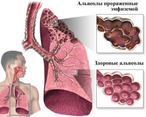 Îndepărtarea toracoscopică a chisturilor pulmonare, emfizemul pulmonar bulos - chirurgia laparoscopică în