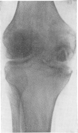 Tuberculoza articulațiilor - pagina 2 din 7 - Diagnosticul radiologic al bolilor oaselor și articulațiilor