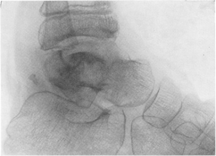 Tuberculoza articulațiilor - pagina 2 din 7 - Diagnosticul radiologic al bolilor oaselor și articulațiilor