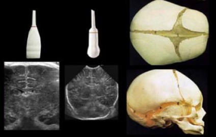 мозъка ултразвук при кърмачета и новородено дете норма, декодиране