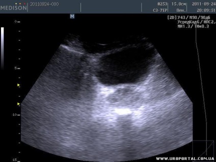 Prostate ultrasunete