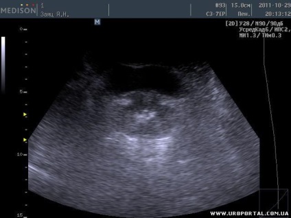 Prostate ultrasunete