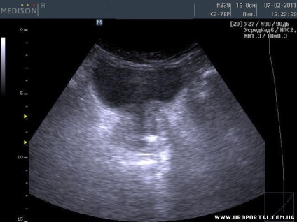 Prostate ultrasunete