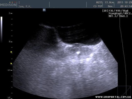 Prostate ultrasunete