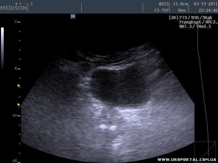 Prostate ultrasunete