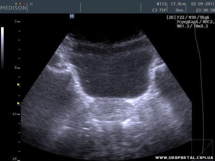 Prostate ultrasunete