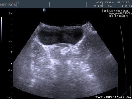 Prostate ultrasunete