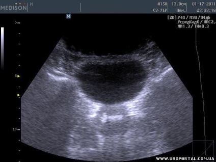 Prostate ultrasunete