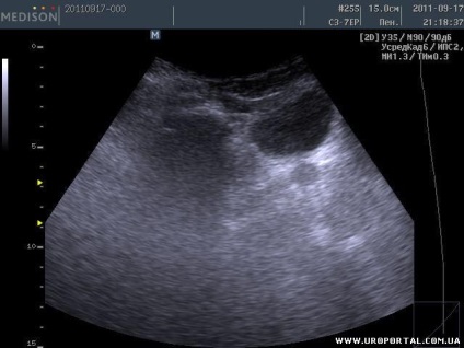 Prostate ultrasunete