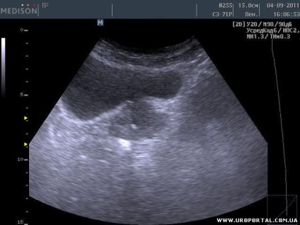 Prostate ultrasunete