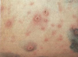 Varicelă (clinică) - infecție herpetică - boli infecțioase la copii - copii - medici