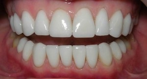 Furnir pe dinți curbate fotografie înainte și după instalarea de suprapuneri pe rândul din față