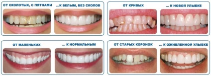 Furnir pe dinți curbate fotografie înainte și după instalarea de suprapunere pe rândul din față