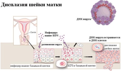 Papilomavirusuri umane cu conținut ridicat de oncogen